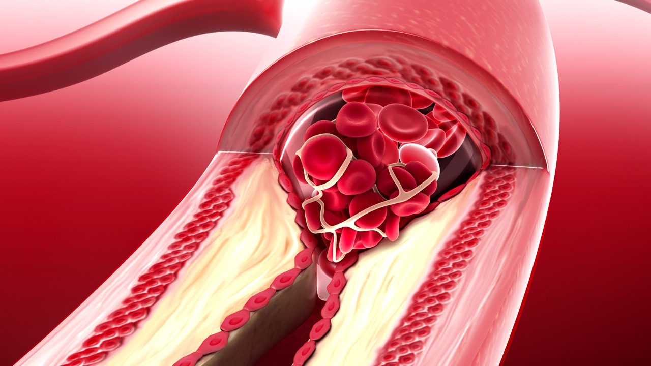 Preventing Atherosclerosis Through Nutrition